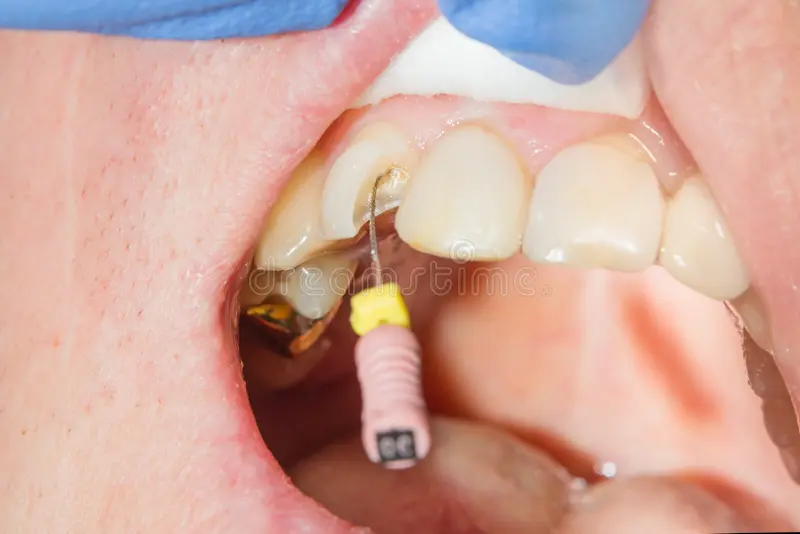 ENDODONTIC TREATMENT