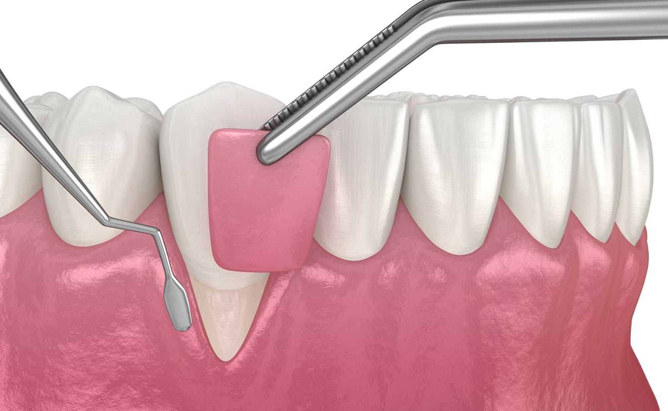 Bone Grafting For Gum Disease