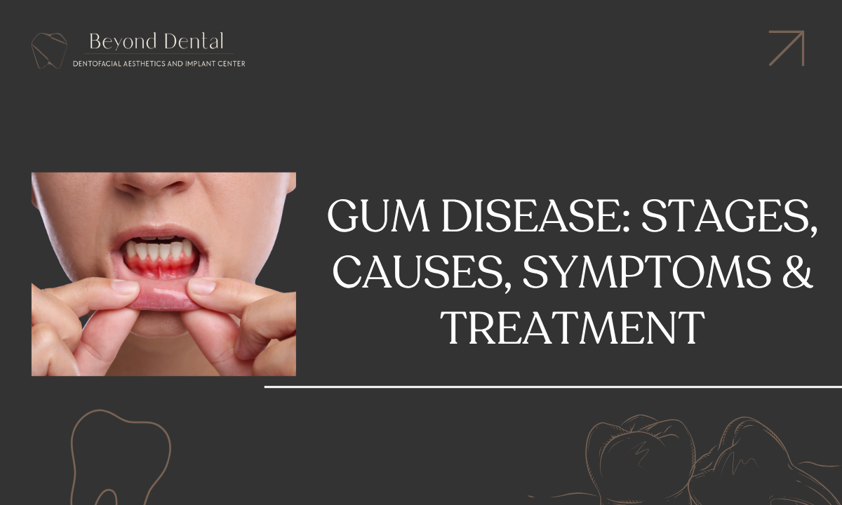 Gum Disease_- Stages, Causes, Symptoms & Treatment