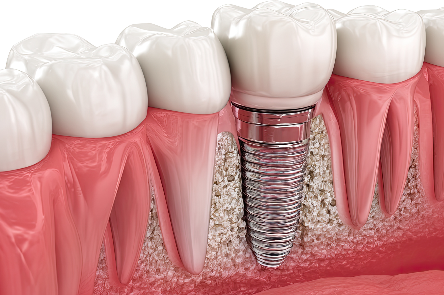 Implant-Supported Dentures