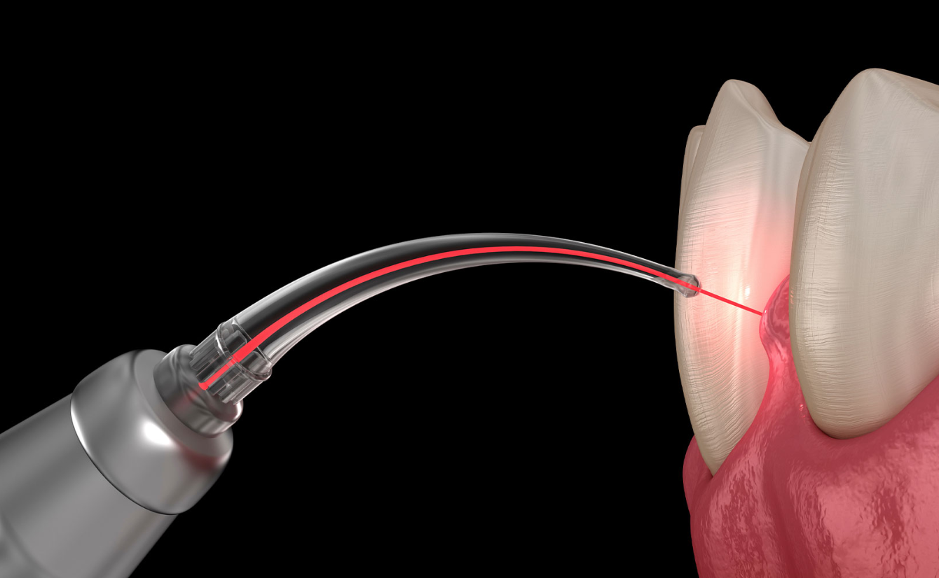 Laser Gum Treatment