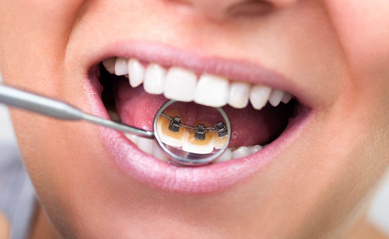 Lingual Braces