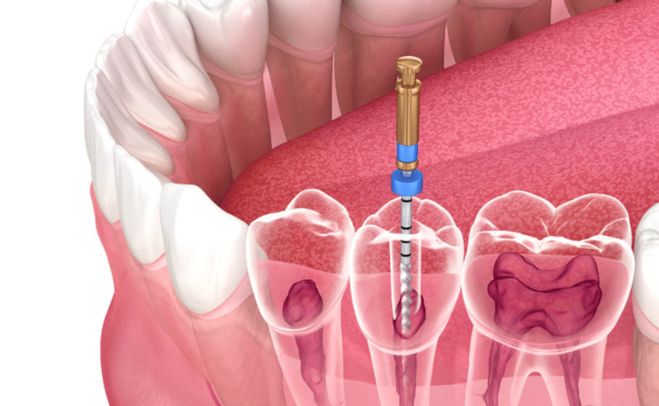 Multiple-Visit Root Canal Treatment