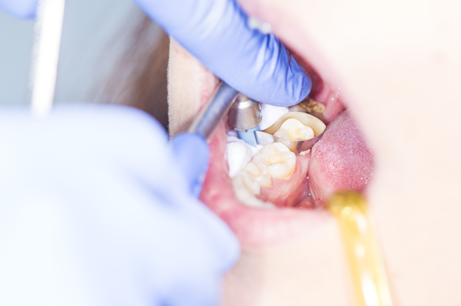 Multiple Wisdom Tooth Extraction