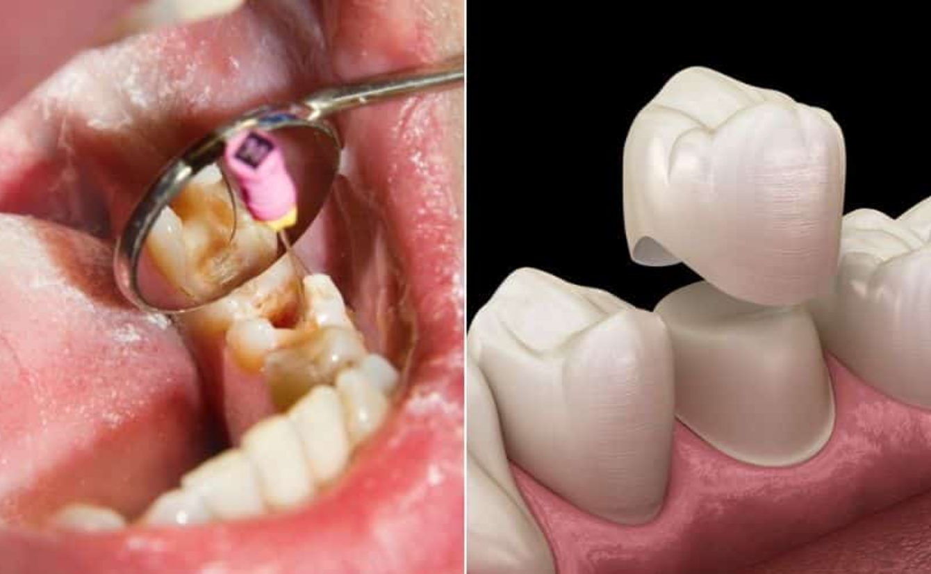 Root Canal Treatment With Crown Placement