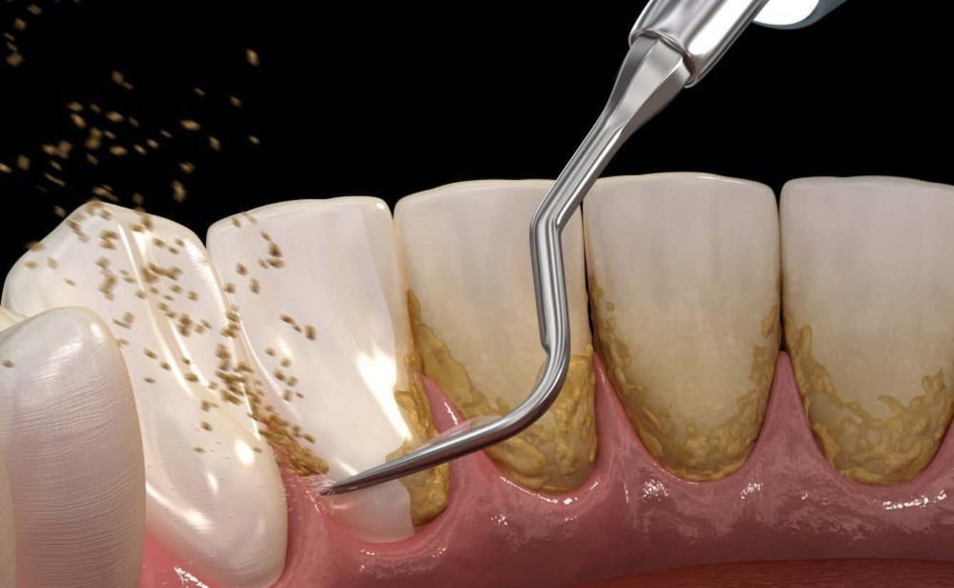 Scaling And Root Planing