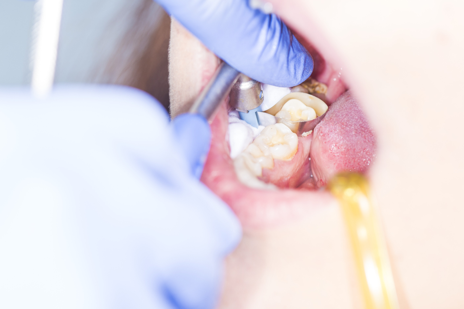 Simple Wisdom Tooth Extraction