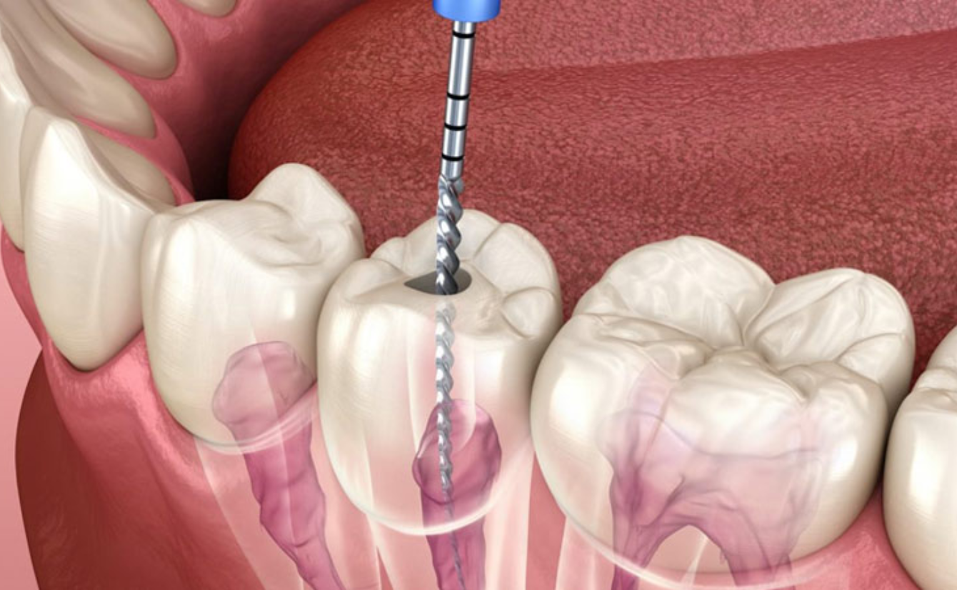 Single-Sitting Root Canal Treatment