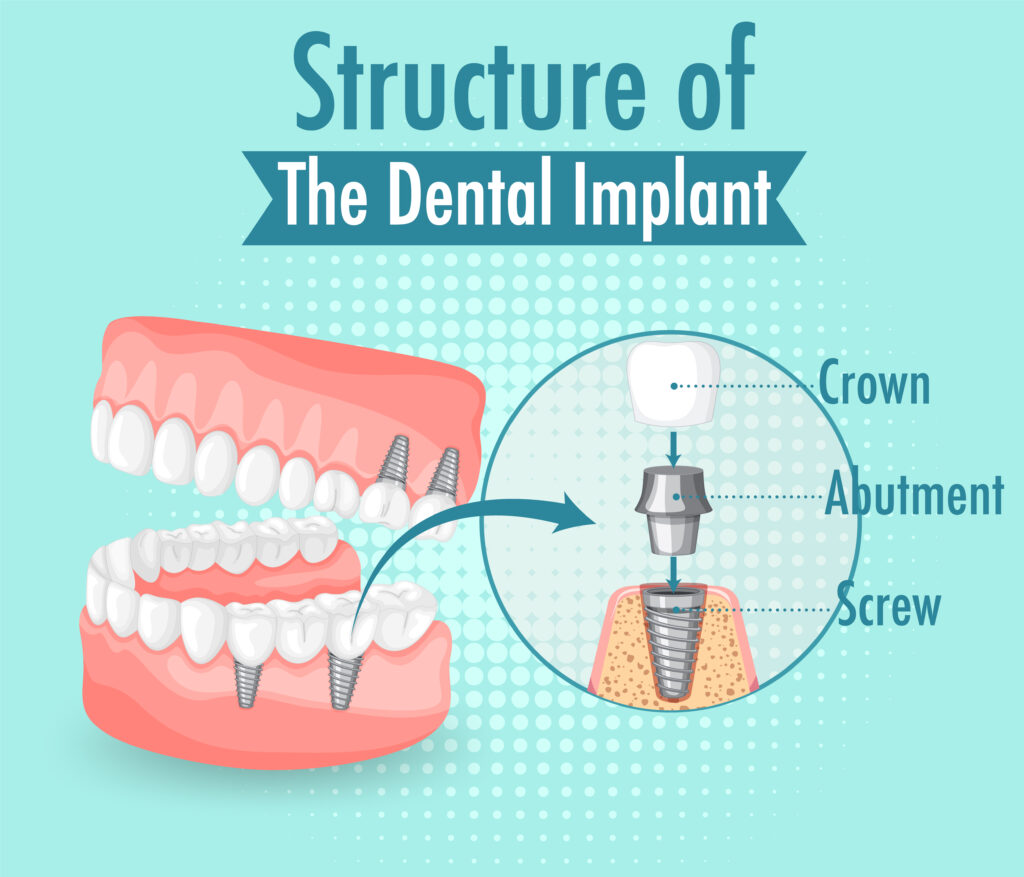 structure of dental implant 