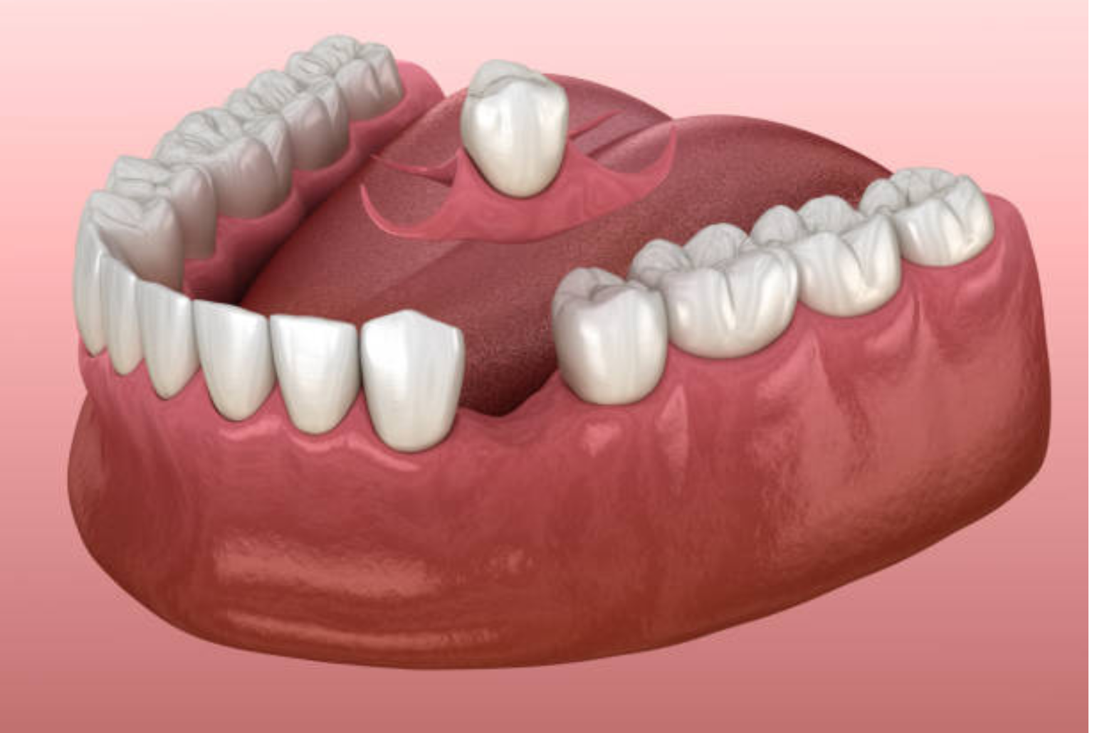 immediate dentures