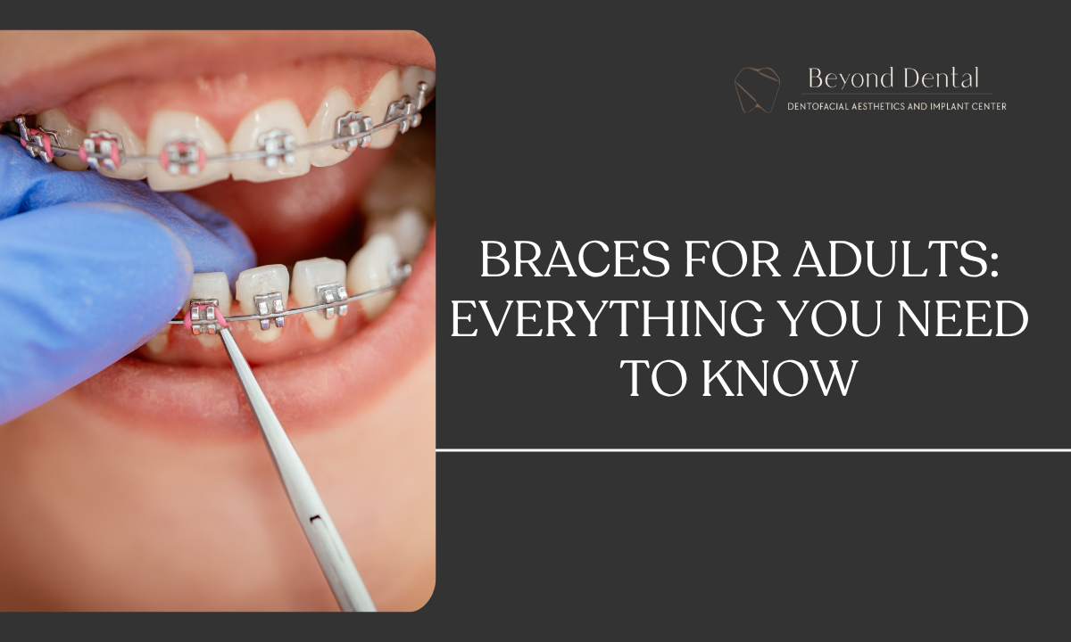 Braces for Adults_ Everything You Need to Know