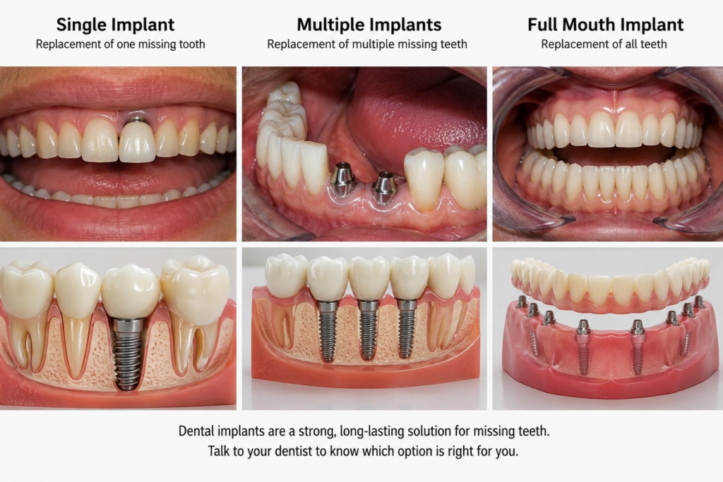 Single, Multiple and Full Mouth Implant Costs Explained