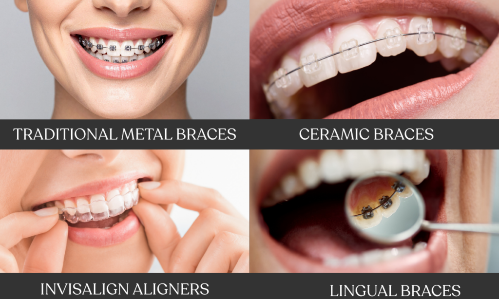 ypes of braces