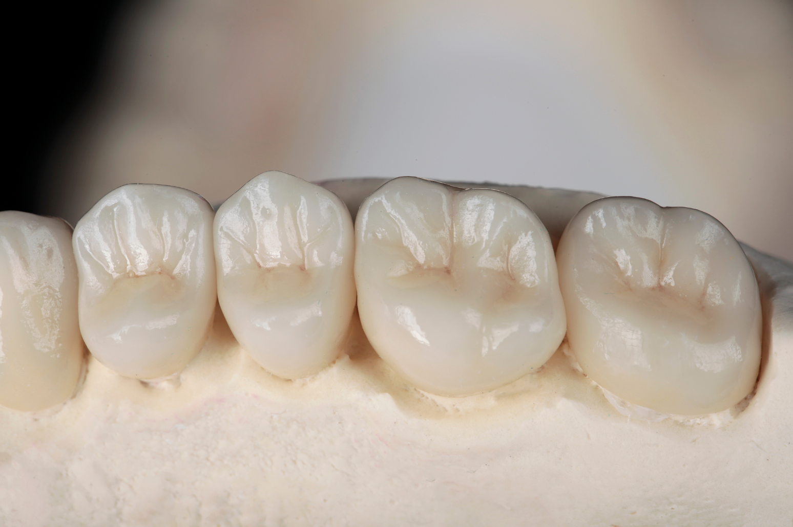 Ceramic Dental crowns