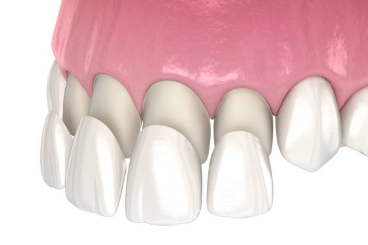 Composite Veneers