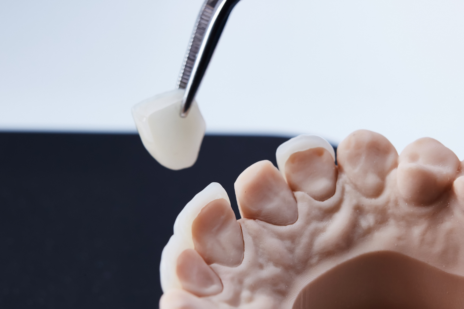 Porcelain Veneers