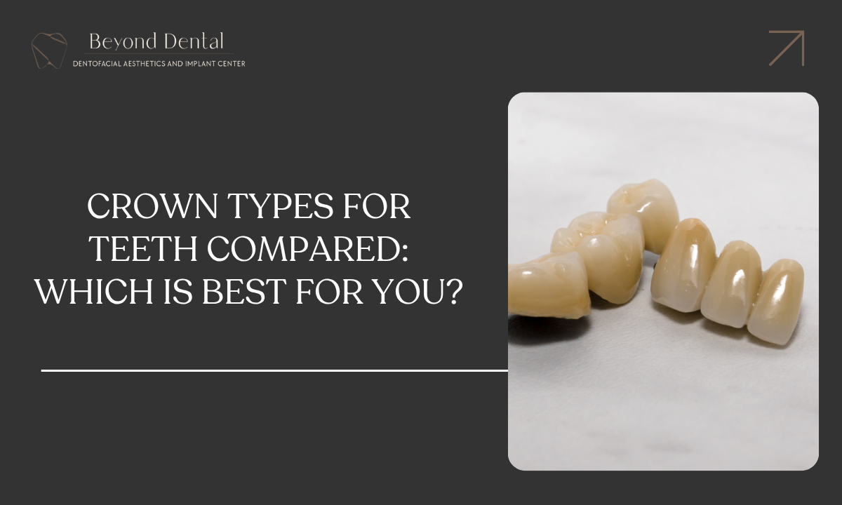 crown types of teeth compared