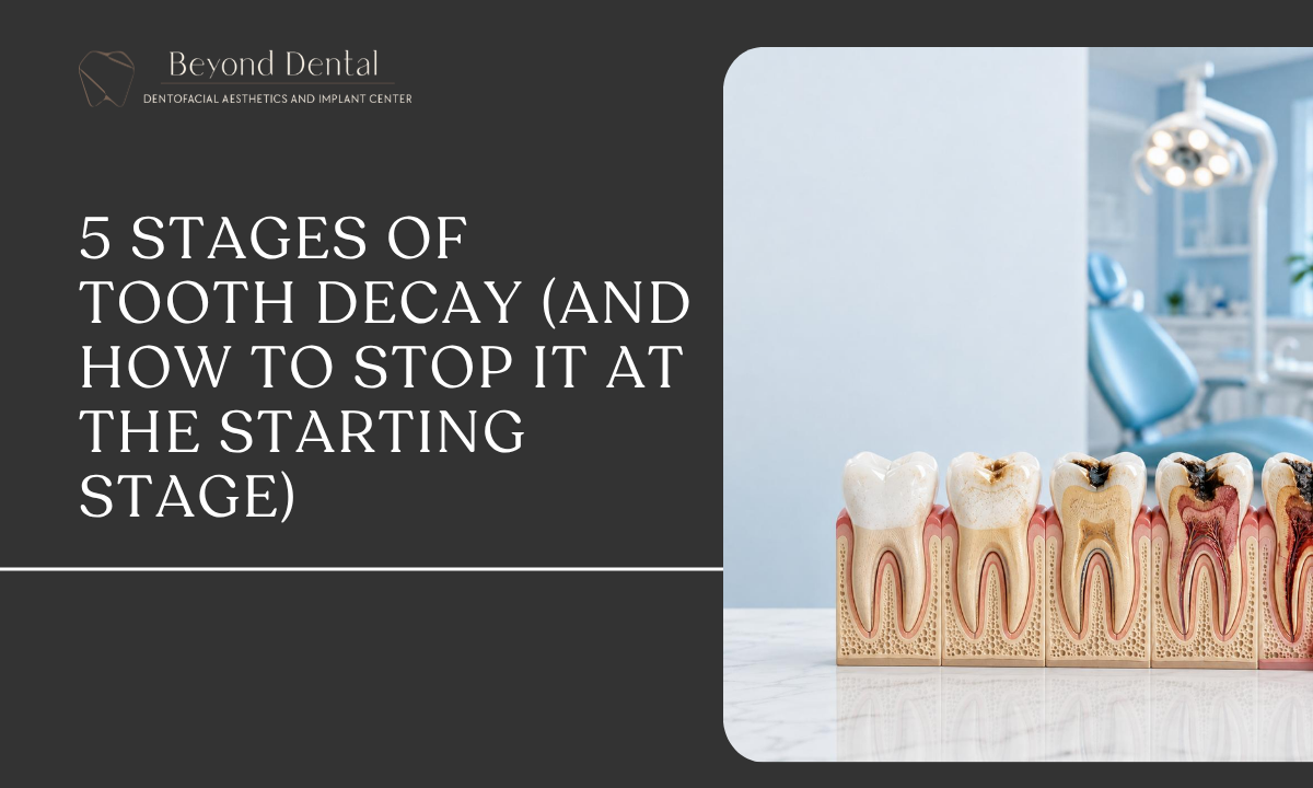 5 stages of tooth decay