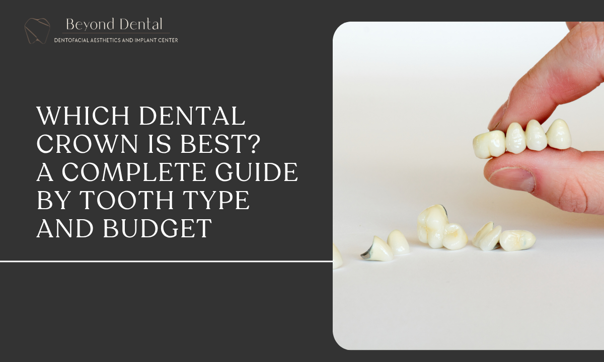 which dental crown is best