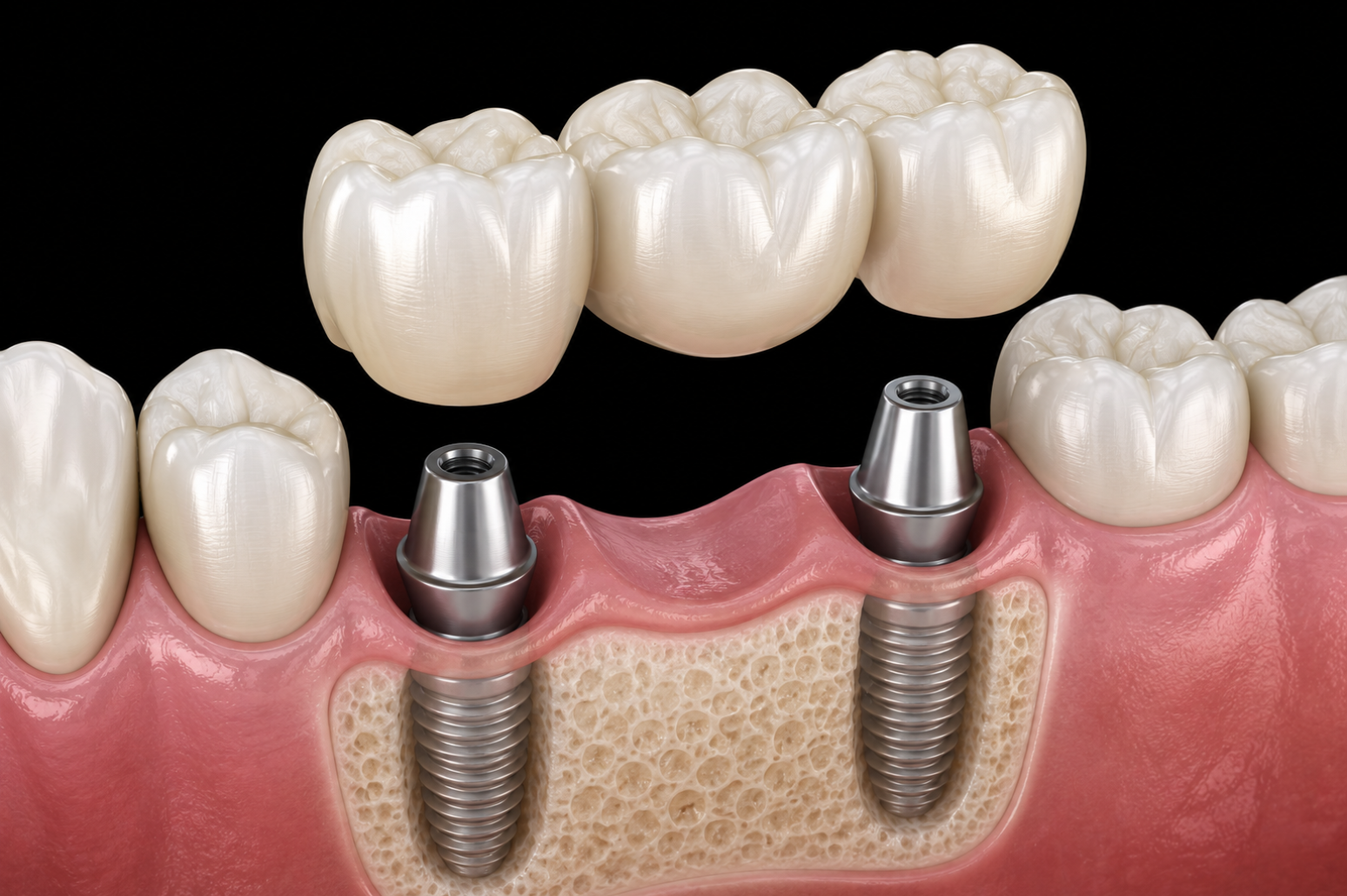 Implant-Supported Bridge