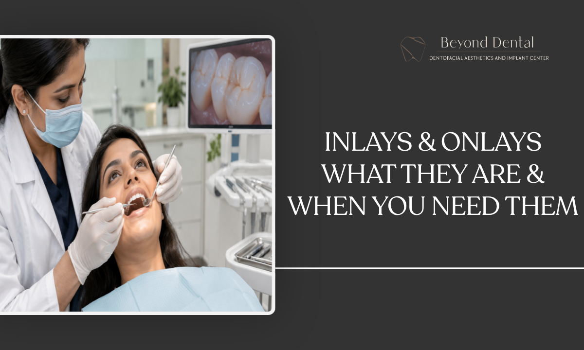 Inlays & Onlays: What You Need to Know