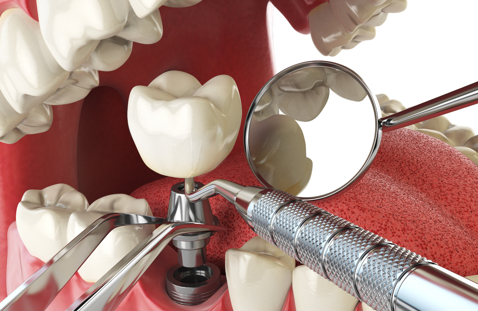 Dental Implant in Bangalore