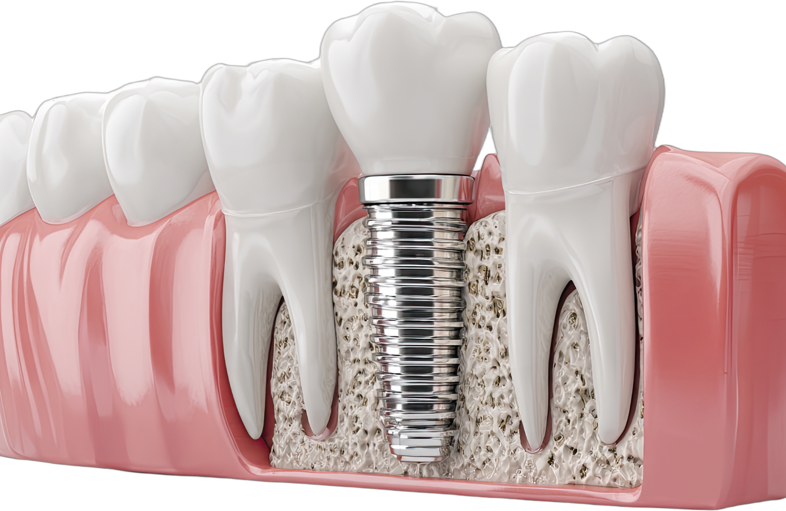 implants prosthodontics