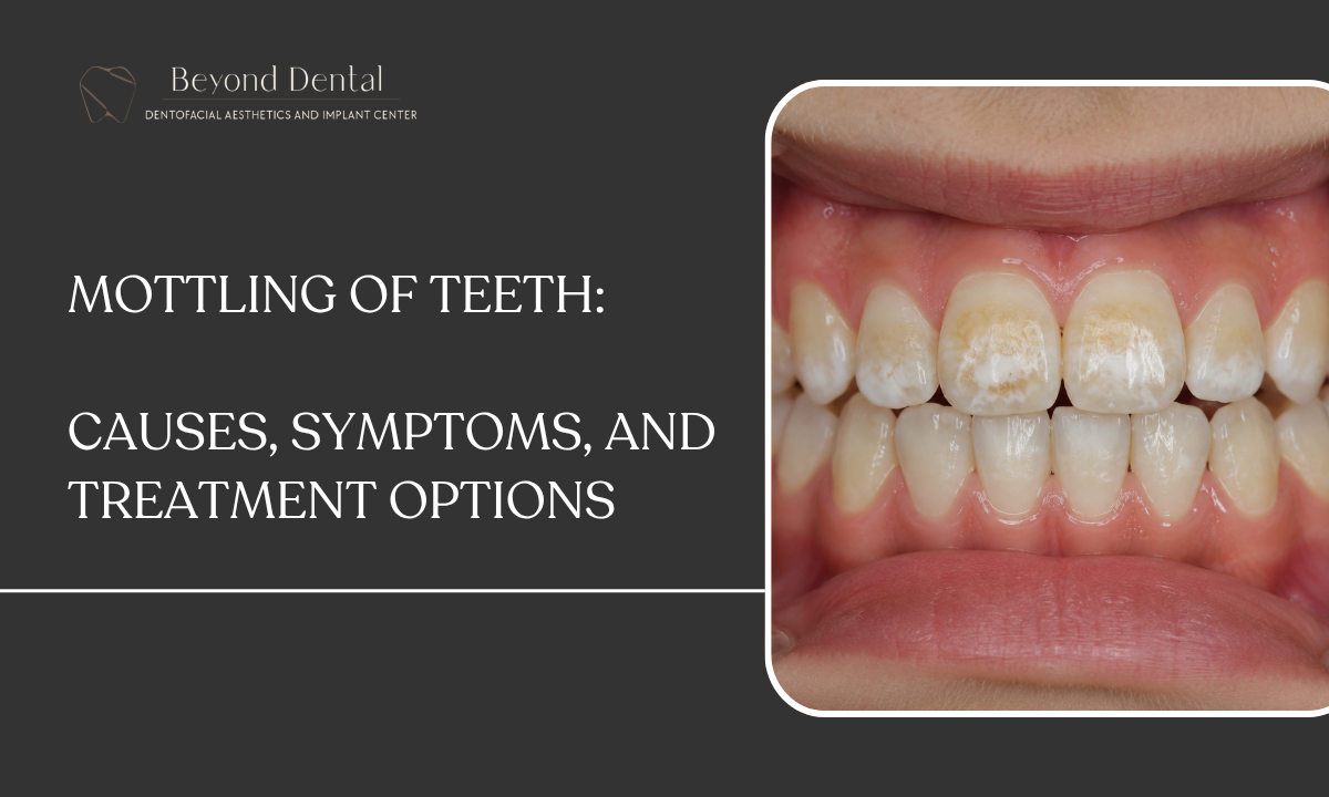 what is mottling of teeth