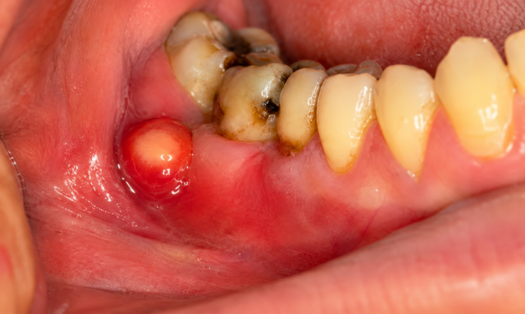 Abscess Formation
