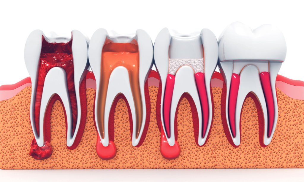stages of root canal treatment